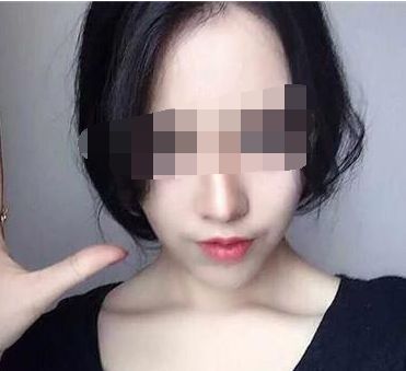 穆雄錚顴骨整形手術解析，修復顴弓美麗重生！顴骨整形術后恢復時間淺析