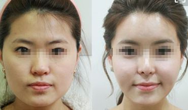 去除眼袋皺紋的五種方法，讓你恢復(fù)年輕青春的秘密！