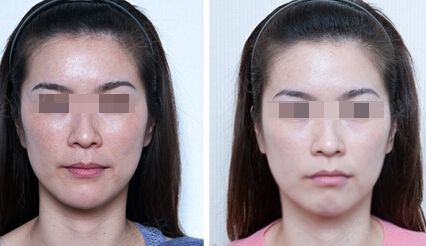 激光治療眼袋需要多少次才能去除眼袋呢