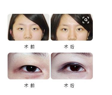 恢復(fù)處女膜：經(jīng)驗(yàn)分享與修復(fù)方法