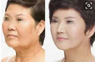 15歲女孩整容成果驚人！爸媽都認(rèn)不出來了