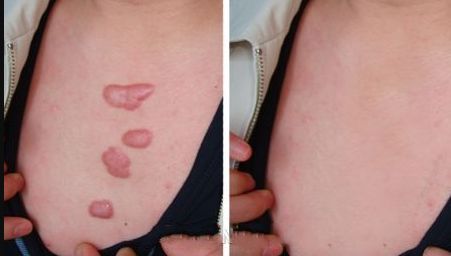 光子嫩膚紅血絲好效果，有效緩解面部紅血絲問題