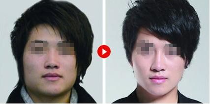 隆鼻修復(fù)，如何科學(xué)達(dá)到理想效果？