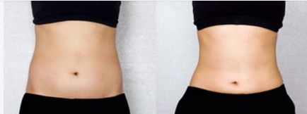 時(shí)尚達(dá)人必選！令人年輕的電波拉皮術(shù)，輕松消除皺紋