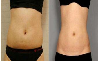 鼻部整形手術(shù)麻醉方式是局部還是全身？