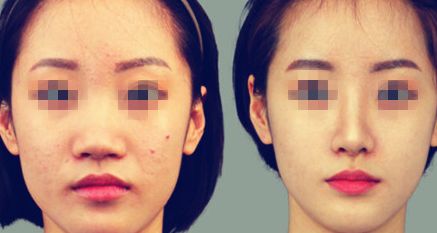 打造精致臉龐 這種法術(shù)你值得擁有！探討瘦臉注射去皺費(fèi)用