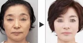 如何使陰道恢復緊致的方法