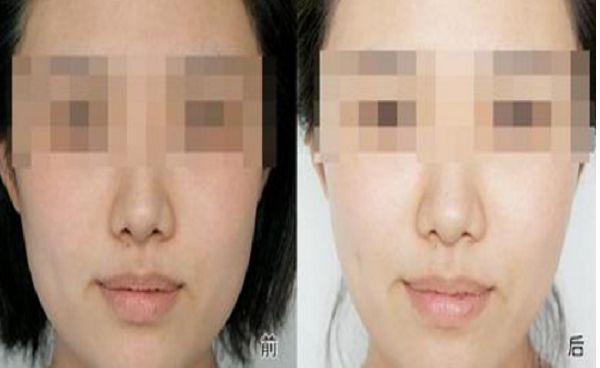 修復(fù)雙眼皮失敗的方法與效果，全面解析助你成功擁有完美雙眼皮