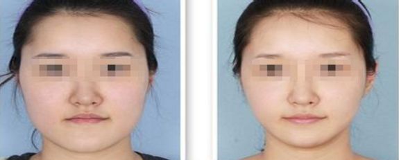 2020年雙眼皮手術(shù)費(fèi)用一覽表，雙眼皮整形手術(shù)價(jià)格查詢