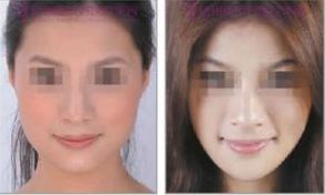 腹部吸脂后如何恢復(fù)均勻平整身材