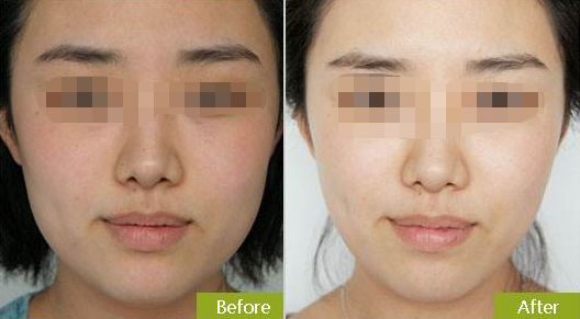 擁有光滑年輕肌膚，無(wú)需手術(shù)的神奇彩光嫩膚方法