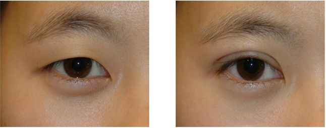 快速消腫：頜角手術(shù)后的飲食推薦有哪些