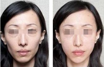 解決鼻炎問(wèn)題的安全鼻整形方式