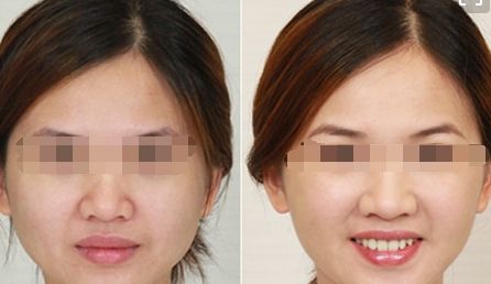 產(chǎn)后腹部吸脂手術(shù)后恢復(fù)時(shí)間有多長(zhǎng)