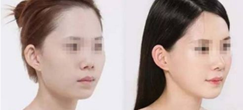 假體隆鼻手術(shù)帶來(lái)正自然效果，狀似真實(shí)鼻形