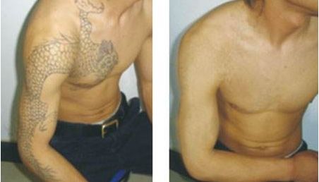 耳軟骨隆鼻術(shù)后的疼痛時(shí)長(zhǎng)與恢復(fù)速度！