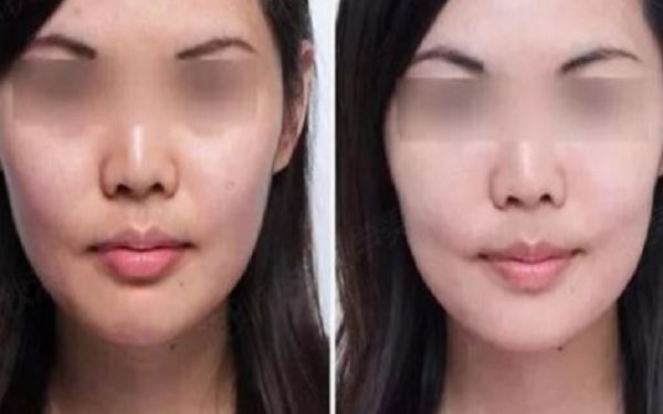 35歲采用超聲療程好還是熱瑪吉更好？匿名評測揭秘！