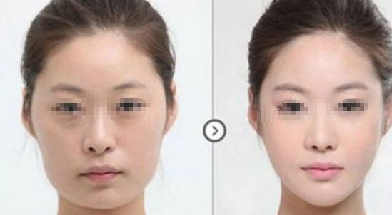 皮膚松弛，如何選擇適合的醫(yī)美項目？熱門方式如熱瑪吉、拉皮等對比解析！