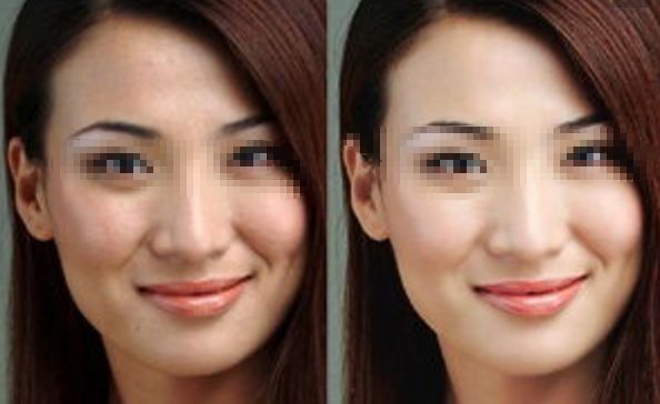 塑料手術(shù)鼻子整形價格參考