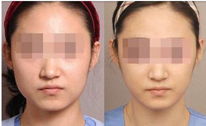 有效去眼袋方法分享：激光手術(shù)后的正確護(hù)理