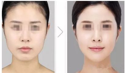 陰道緊縮術(shù)是否痛苦，了解手術(shù)前后的疼痛情況