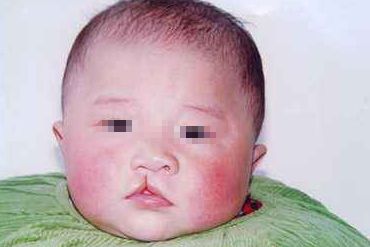 處女膜修復(fù)術(shù)后多久能恢復(fù)正常？