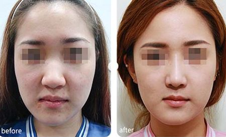 個(gè)性化整容美容的熱門技術(shù)及持久時(shí)間