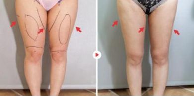 高效祛除眼袋的有效修復方法