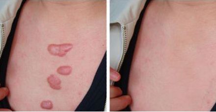 美腿塑造：疤痕會(huì)影響自體脂肪豐臀效果嗎？