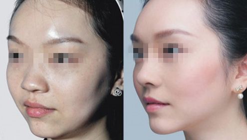 頜角磨骨整形手術(shù)及適應(yīng)者的詳細(xì)解析