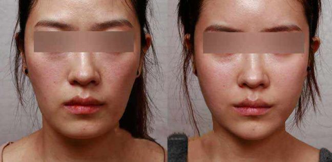 眼袋手術(shù)后效果持續(xù)多久？解析專家分享