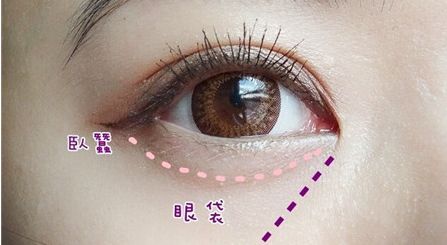 提升眼部神采！揭秘上瞼下垂手術(shù)的科學(xué)原理