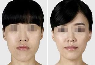 肋骨隆鼻后的面部消腫需要多長時間？消腫小竅門曝光！