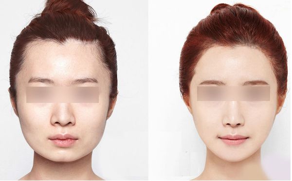 腹部吸脂后需注意的事項，了解嗎？