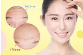 開內(nèi)眼角手術的疼痛程度如何？解析內(nèi)眼角手術的全貌