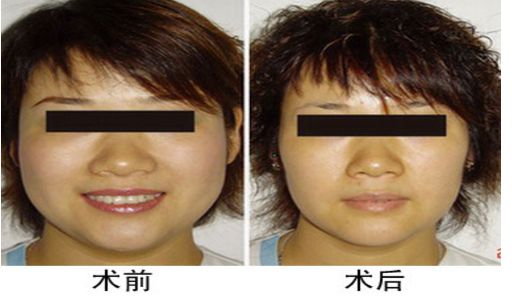 咬肌切除手術(shù)后對面部功能是否會受影響？