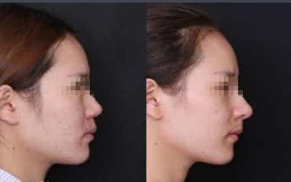 全切雙眼皮修復(fù)時間要多久？全切失敗可選擇埋線嗎？