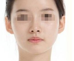 愛貝芙注射的絕佳效果時(shí)間揭秘