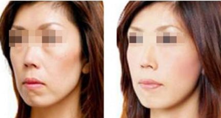 術(shù)后脂肪填充面部消腫時長及護理指南速查