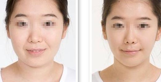 隆鼻手術(shù)失敗，修復(fù)需謹(jǐn)慎，風(fēng)險不可忽視