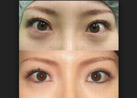 術(shù)后如何正確護理假體豐胸，讓你更安心！