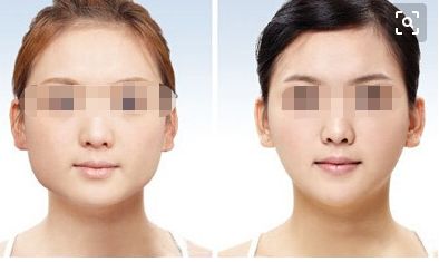 透明質(zhì)酸隆鼻：如何有效延長效果期限？自體軟骨隆鼻：維持力究竟有多久？