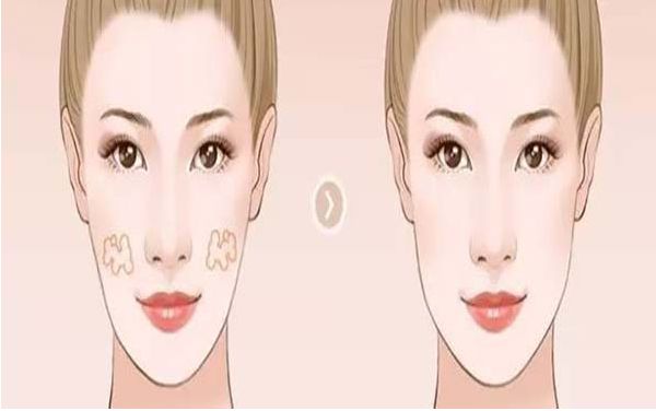 運(yùn)動(dòng)中女性做隆胸需要注意的事項(xiàng)