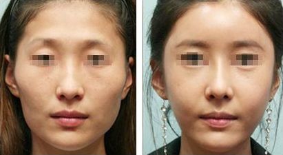 雙眼皮修復(fù)的關(guān)鍵時(shí)期，如何有效解決手術(shù)失敗問(wèn)題？