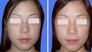 祛除眼袋與抽脂術(shù)哪種更有效？