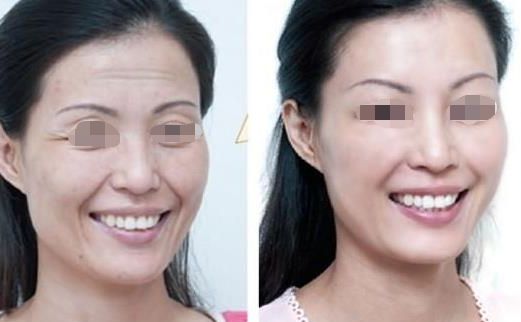 面部吸脂瘦臉效果如何？達(dá)到自然效果的關(guān)鍵是什么