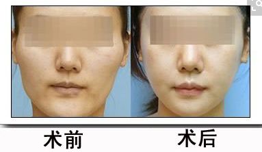 鼻骨矯正對外貌有何影響？矯正費用合理嗎？