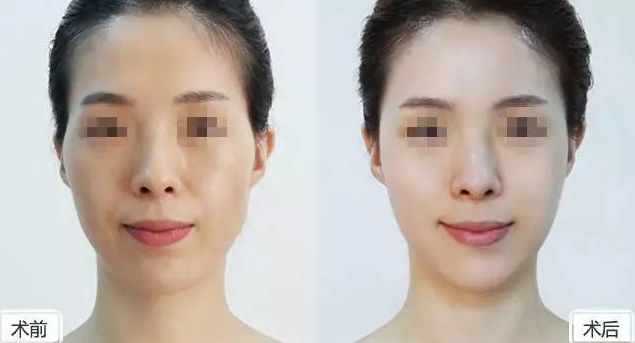 假體隆胸保持持久效果有多久？假體隆胸2個(gè)月后是否固定？