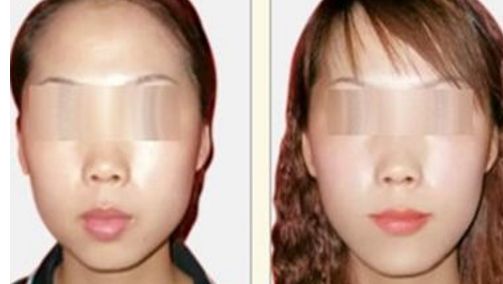 打造明亮迷人雙眼，領(lǐng)略三點(diǎn)雙眼皮手術(shù)的魅力