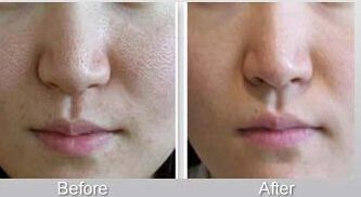 鼻整形手術(shù)后恢復(fù)需要多久？隆鼻與注射隆鼻的恢復(fù)時(shí)間對(duì)比！